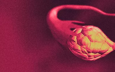 Câncer de ovário: prevalência e desafios no Brasil